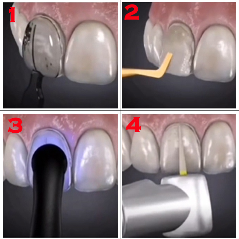 Molde de Facetas Dentárias Aut - Teeth Whitening Moulds avaliação e preço