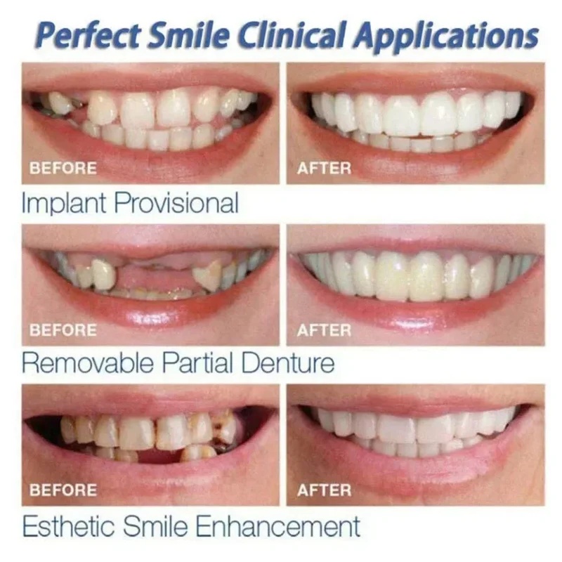 Kit de Dentes de Faceta Snap-o - Teeth Whitening Kit avaliação e preço